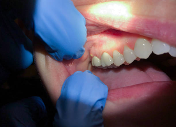 Best Emergency Dental Care for Abscessed Tooth in Mona, UT